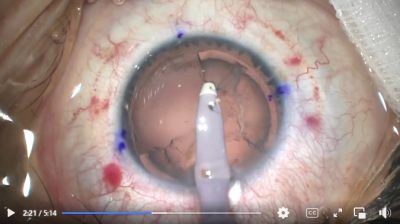 elos surgery 2